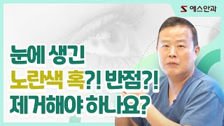 눈에 생긴 노란색 혹?! 반점?! 제거해야하나요?