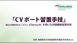 DEWXを用いた内頚静脈留置手技