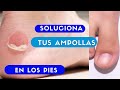 Como tratar las ampollas en los pies