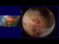 Live Demonstration of Superior Capsular Reconstruction | Brian J. Cole, MD, MBA