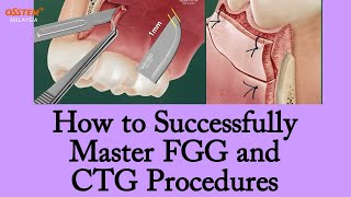 Surgery Series 3(5): How to Successfully Master FGG and CTG Procedures