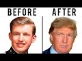 Donald Trump's Hair Transplant | Plastic Surgery Analysis