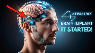 Neuralink Brain Implants Begin: The Greatest Change in Our Times! (What You Should Know)
