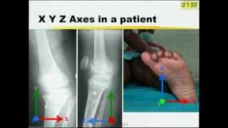 Six Axis deformity correction