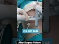 Breast Implant Surgery Scar? | Breast Implant Surgery in Hindi