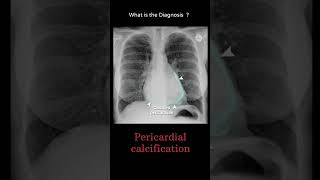 Pericardial calcification 157 chest X-ray Quiz Cardiac disease #@radiologychannel007