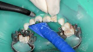 Rebuilding an upper primary ante. tooth using a SC, voiceover US