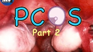 PCOS Explained Part 2