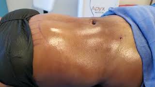 After VASER liposuction with Renuvion Skin tightening