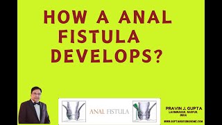 HOW ONE DEVELOPS AN ANAL FISTULA?