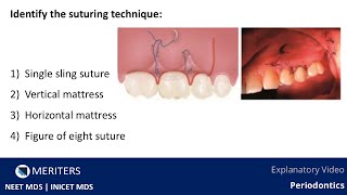 NEET MDS | INICET - Periodontology - Flap \u0026 Mucogingival Surgery | Explanatory Video | MERITERS