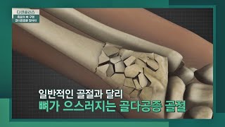 전신에 각종 질병을 유발할 수 있는 '골다공증 골절' 방치💦 | 다큐 플러스 254회 | JTBC 230326 방송