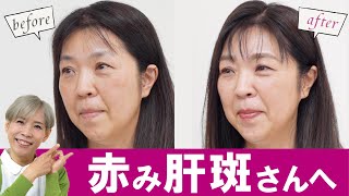 【赤み肝斑】 40代 50代のお悩みをヘアメイクで解決