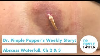 Dr. Pimple Popper's Weekly Story: Abscess Waterfall Ch 2 & 3!