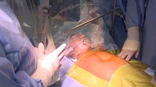 Live Surgery Demonstration Case 1