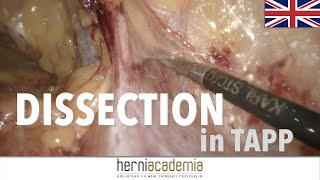 TAPP full video - How to dissect in laparoscopic groin hernia repair ?