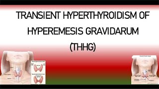 Transient Hyperthyroidism of Hyperemesis Gravidarum  | Gestational Transient Thyrotoxicosis (GTT)