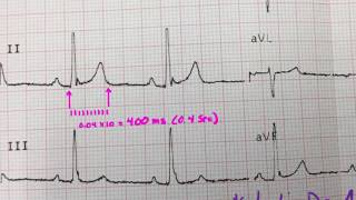 The Qt interval