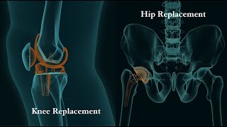 Virtual Total Joint Replacements