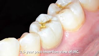 Extraction, Immediate Placement, and Restoration of a Mandibular Primary Molar with an IAC