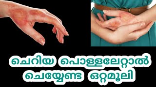 Home remedies of Hand Burns |പൊള്ളൽ |  | Malayalan