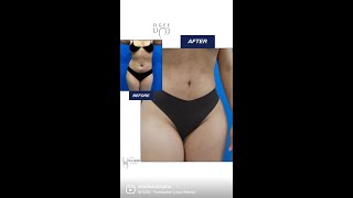 BBL with Ogee Lipo