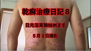 乾癬）乾癬治療日記8。乾癬やアトピーに日光浴は効くのか？グロ注意（psoriasis）（银屑病）