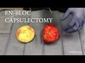 EN BLOC CAPSULECTOMY REMOVAL