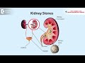 kidney stone diet foods to eat and avoid prevention of stones dr.girish nelivigi doctors circle