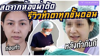 สดจากห้องผ่าตัด!!? รีวิวทำตาทุกขั้นตอน จากชั้นตาไม่เท่ากันกลายเป็นชั้นตาสายฝอ