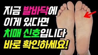 발바닥에 이게 있다면 치매가 오는 신호입니다! 바로 병원가세요! [치매예방, 치매초기증상, 치매조기진단, 치매조기치료, 치매예방음식]