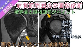 肩関節周囲炎の画像診断