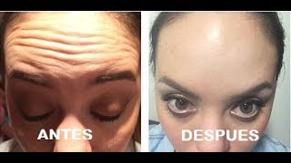 Cremas para arrugas en la frente con efecto botox lifting inmediato