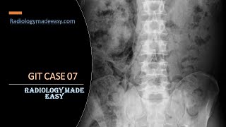 A 63 year old known diabetic patient presented with high fever spikes | FRCR Radiology GIT Cases 07