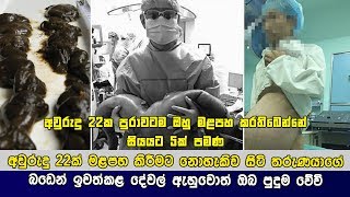 අවුරුදු 22ක තරුණයෙක්ගෙ යෝධ බඩෙන් එළියට ගත්තු කිලෝ 14ක මළපහ