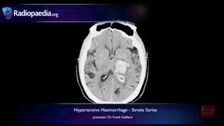 Stroke: Hypertensive haemorrhage - radiology video tutorial (MRI, CT)