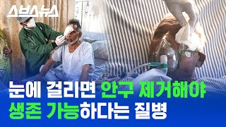 한국에도 감염자 있다는 치사율 50% 털곰팡이, 사람 간 전염될까? / 스브스뉴스