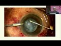 aioc2022 ic383 topic dr ashok kumar key note white mature cataract