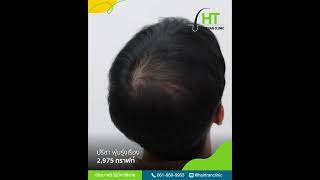 ใครว่าหัวล้านกลางศีรษะปลูกผมไม่ได้? | คุณหมอแพตตี้ - Hairtran Clinic