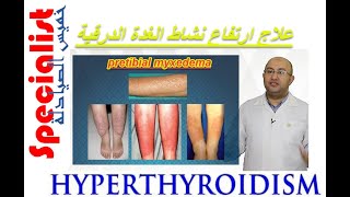 15| Hyperthyroidism| ارتفاع نشاط الغدة الدرقية | الادوية المساعدة | اندرال اقراص | خميس الصيادلة