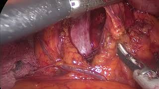 Laparoscopic para-aortic lymph nodes sampling before pancreatectomy for cancer