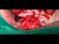 Crestal approach with Membrane Control(Live Surgery) - IBS Implant