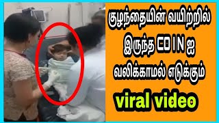 குழந்தையின் வயிற்றில் சிக்கிய COIN ஐ வலிக்காமல் எடுக்கும் அருமையான வீடியோ