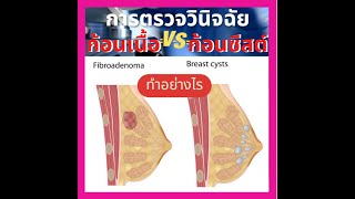 การตรวจวินิจฉัย ก้อนเนื้อและก้อนซีสต์ ทำอย่างไร?