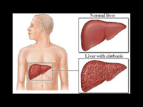 Natural and Home Remedies for Liver Cancer Natural and Home Remedies for Liver Cancer