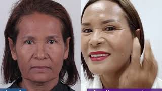 รีวิวดึงหน้า Facelift เฟซล็อค ดีต่อใจ!!! รีวิวดึงหน้าครบ 12 วัน คุณพี่ขวัญ อายุ 63 ปี