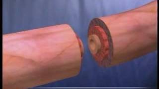 Tubal Ligation (Tubes Tied) Video