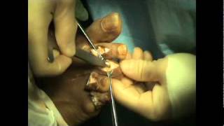 Hammer Toe/Smart Toe Surgery - Dr. Sherman Nagler - Houston's Foot Doc