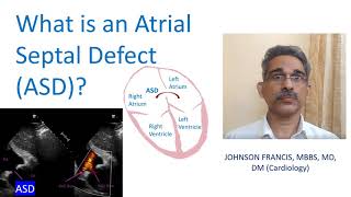 What is an Atrial Septal Defect ASD?