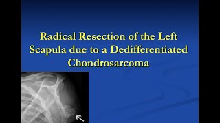 Limb Sparing Resection for a Scapula Dedifferentiated Chondrosarcoma: Restoring Shoulder Stability